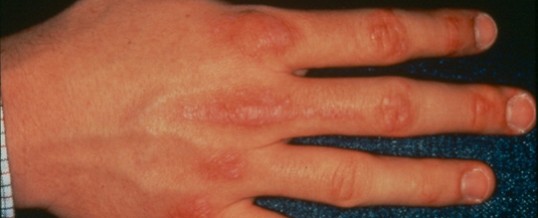skin rashes - WebMD