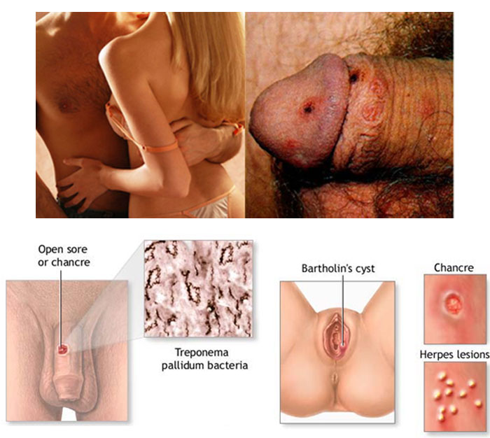 treatment sexual transmitted disease treatment sexual transmitted disease