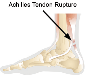 Achilles Tendinitis