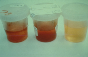 What are some causes of cloudy urine?